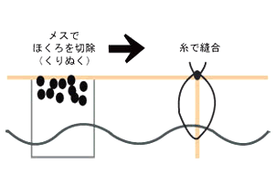 ほくろの切除