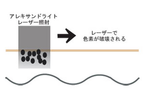 ほくろのアレキサンドライトレーザー治療