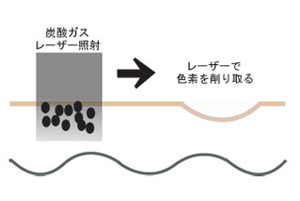 ほくろの炭酸ガスレーザー治療