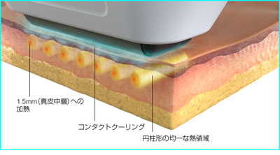 さらにコンビネーション治療 「スペクトラ　デュアルピール」で 相乗効果を期待！！